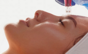 Micro-needling with PRP 